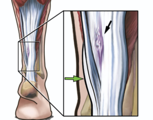 Achilles tendon damage