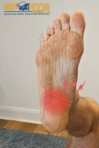 Area of discomfort of plantar heel pain