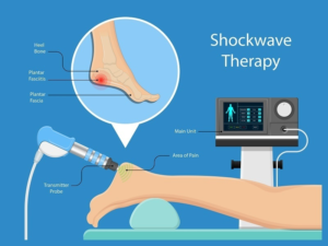 Shockwave for plantar fasciitis