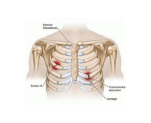 Rib-stress-fracture