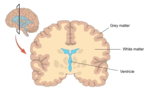 White matter in brain