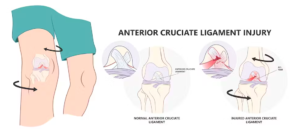 Mechanism of injury ACL