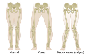 Varus knee