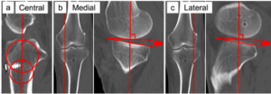 Tibial slope